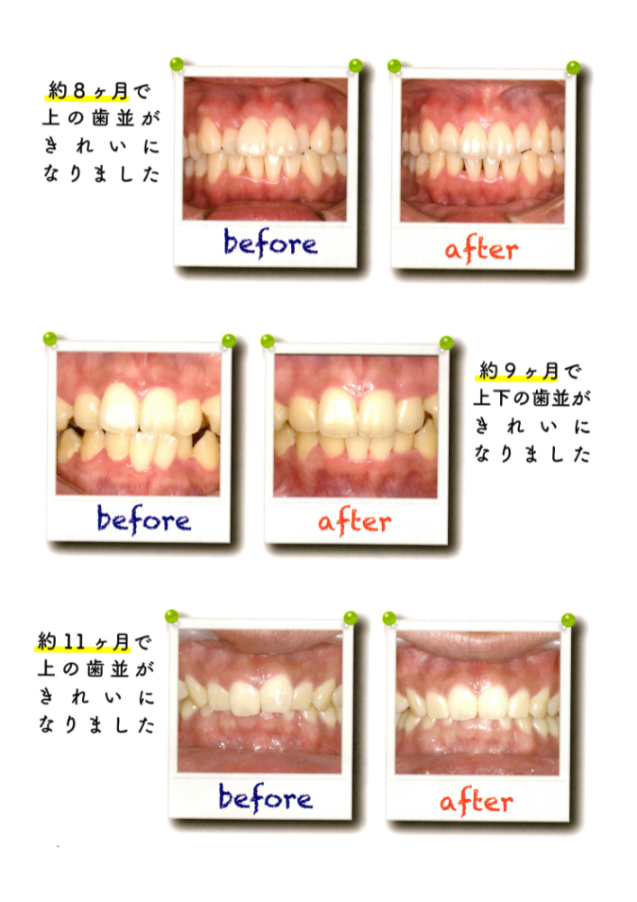 マウスピース矯正の前と後を比較した写真