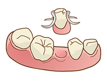 部分入れ歯のイメージ画像