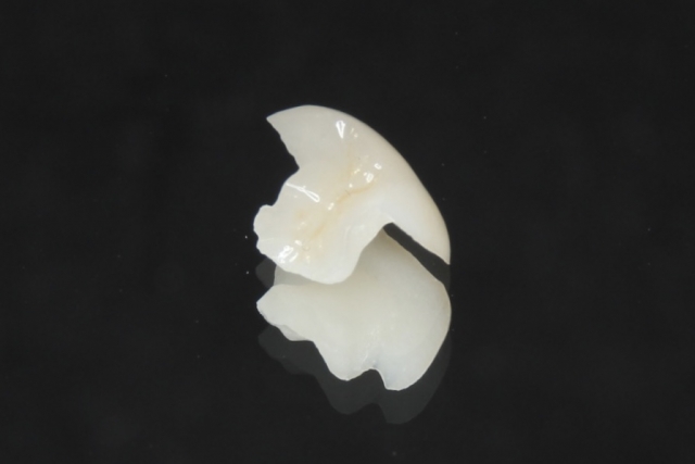 セラミックインレー
