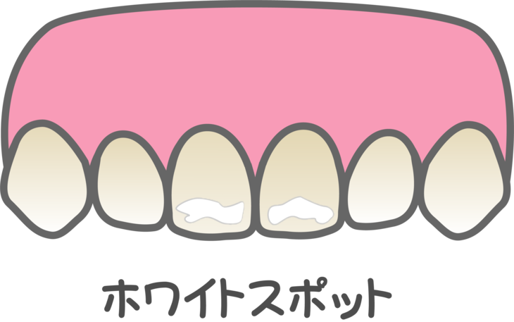 ホワイトスポットイメージイラスト
