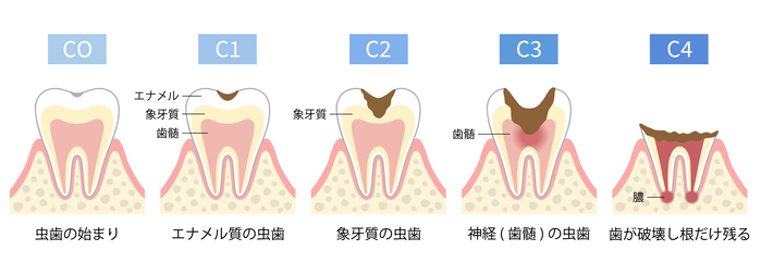 虫歯の進行と症状
