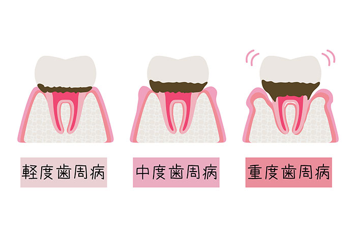 歯周病の軽度、中度、重度の移り変わりを表したイラスト